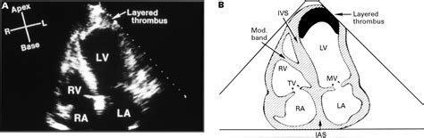 what is an apical thrombus